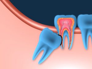 'impacted wisdom tooth'